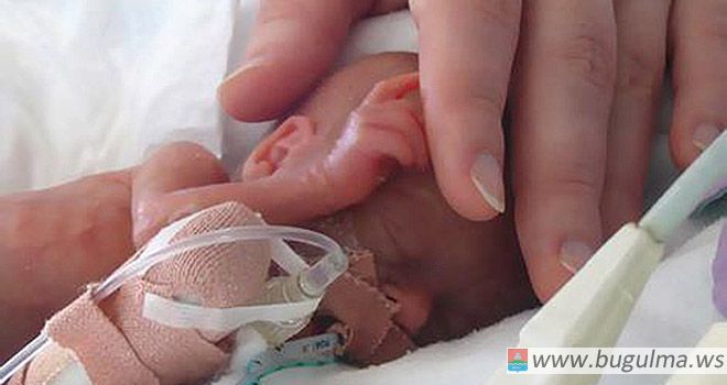 В Набережных Челнах из КДМЦ выписали девочку, родившуюся с экстремальной низкой массой тела